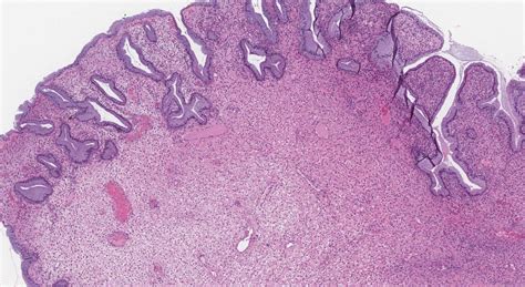 Endocervical polyp | Ottawa Atlas of Pathology