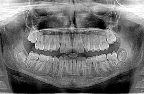 The Science of Modern Dental X-Rays | Grafton Dental Care