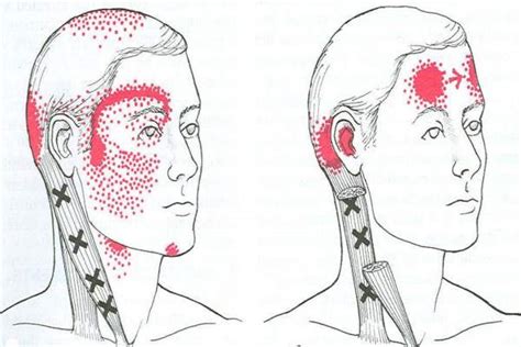 6 Headache Locations and Their Causes | Treat Headaches