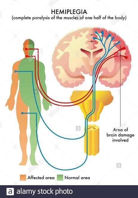 What is hemiplegia? - Quora