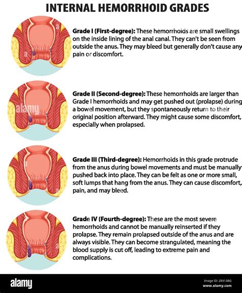 Learn about the different grades of internal hemorrhoids in this ...