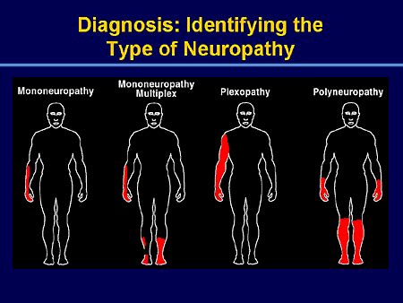 Useful Facts About Neuropathy | Neuropathy and HIV