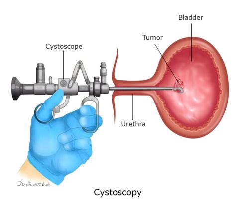 Urinary Bladder Tumour Surgery is done for these SYMPTOMS - Cancerclinix