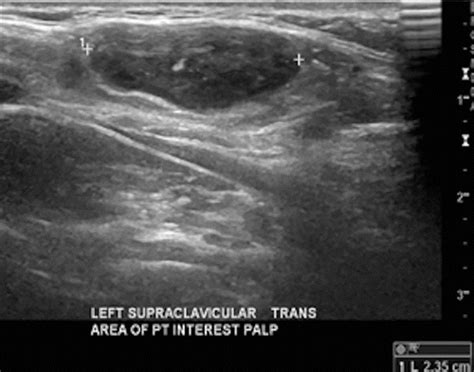 Supraclavicular Lymph Nodes Ultrasound - Ultrasound Of Superficial Lymph Nodes Sciencedirect ...