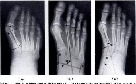 [PDF] Metatarsus primus varus. A statistical study. | Semantic Scholar