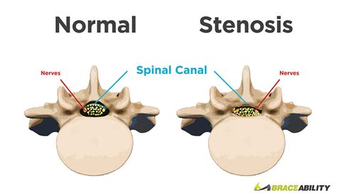 Back Braces & Treatments for Spinal Stenosis | BraceAbility