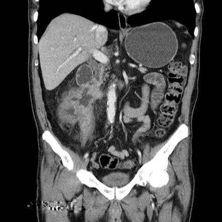 Colo-enteric fistula | Radiology Reference Article | Radiopaedia.org