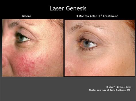 Laser Genesis - Tamra Bedford, Cosmetic RN (925) 518-5212