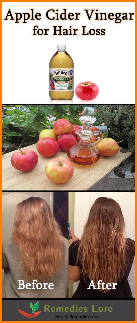 Apple Cider Vinegar for Hair Loss - Remedies Lore