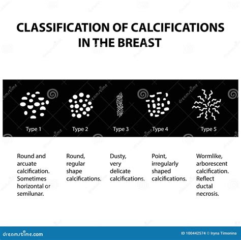 Classificazione Delle Calcificazioni Nella Ghiandola Mammaria Mammography La Ghiandola Mammaria ...