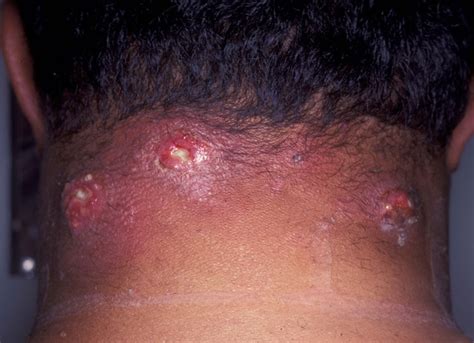 Carbuncle - Pictures, Symptoms, Causes, Treatment and Removal