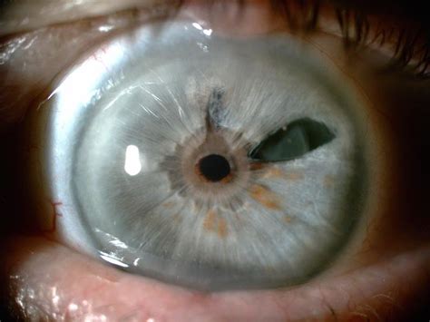 Rupture-like damage to the iris tissue revealing the lens underneath it ...