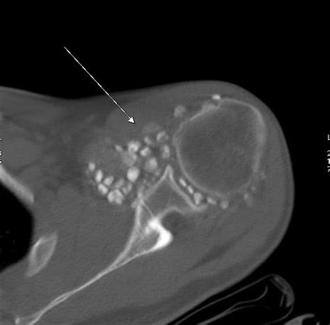 Synovial Osteochondromatosis of Shoulder - Sumer's Radiology Blog