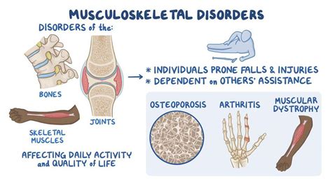 Musculoskeletal system: Musculoskeletal disorders - Osmosis Video Library