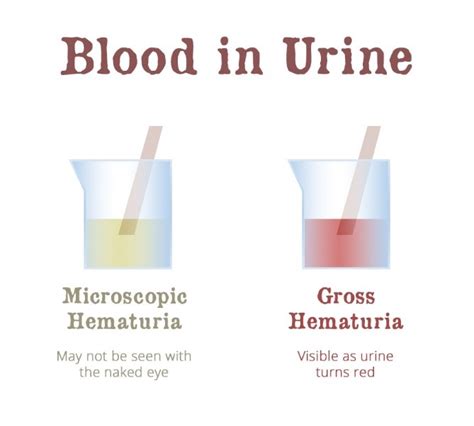 Hematuria (Blood in the Urine) - ASUI