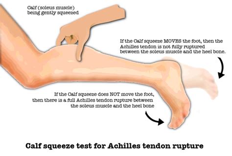 Pulled Achilles Tendon Symptoms