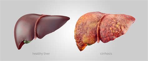 Cirrhosis, Fibrosis, Fatty Liver Disease & Liver Cancer | New Jersey Medical Malpractice Lawyers