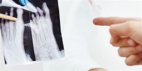 Sprained Big Toe vs. Broken Big Toe: Signs, Symptoms & Treatment Options