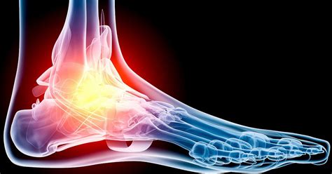 Common Running Injuries: Foot Pain