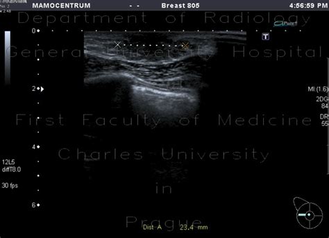 Radiology case: Gynecomastia