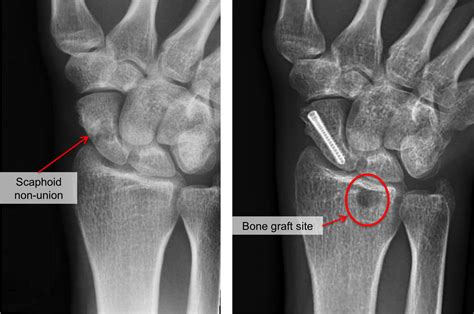 Scaphoid Fracture - Raleigh Hand Surgery — Joseph J. Schreiber, MD