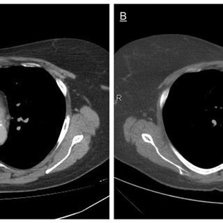 (A) CT scan showing enlarged mediastinal lymph nodes compatible with... | Download Scientific ...