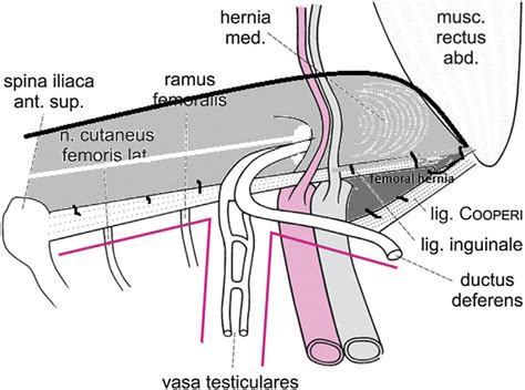 The mesh is sutured to the Cooper's ligament first and to the inguinal ...