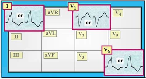 ECG Interpretation: ECG Interpretation Review #11 (BBB, Wide QRS, ST Changes with BBB, LBBB vs ...