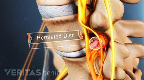 Anatomy of a Herniated Disc