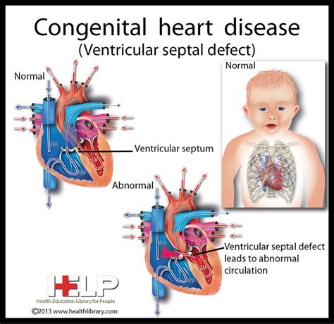 Congenital: What Is Congenital Heart Defect