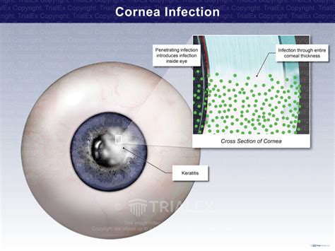 Cornea Infection - Trial Exhibits Inc.