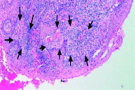 Giant Cell Granuloma Pathology Outlines