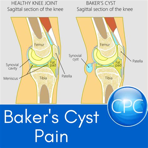 Baker's Cyst Pain | Carolina’s Pain Center