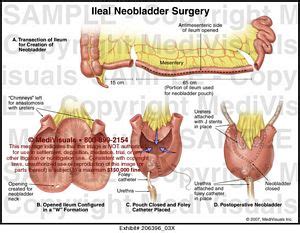 Ileal Neobladder Surgery Medical Illustration Medivisuals