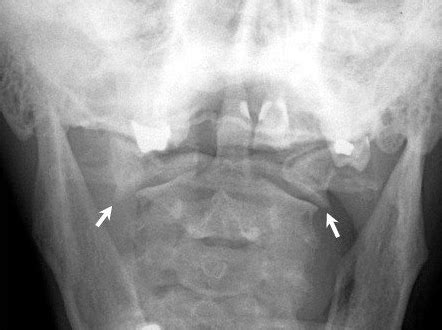 Atlas Fractures & Transverse Ligament Injuries - Spine - Orthobullets