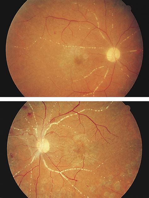 Occlusive Retinal Vasculitis Associated With Systemic Lupus ...