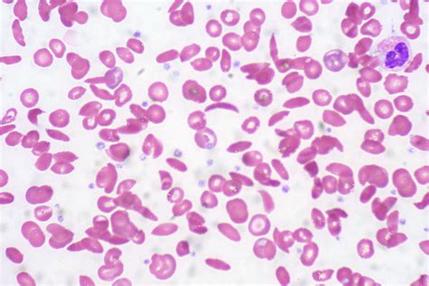 Sickle Cell Anemia | Peripheral blood smear | Ed Uthman | Flickr