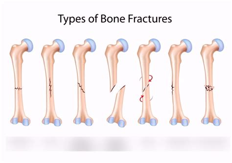 Fractures Diagram | Quizlet