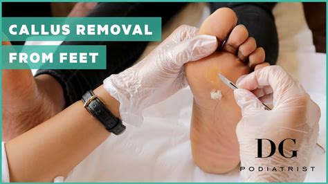 Foot Callus Remover Remedies – Foot Care Tips