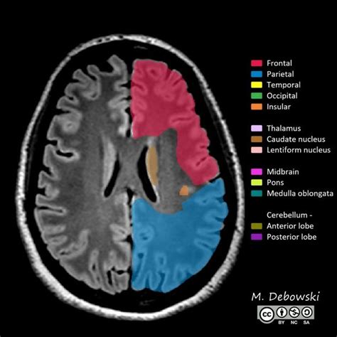 Cerebral hemisphere | Radiology Reference Article | Radiopaedia.org | Medical radiography ...