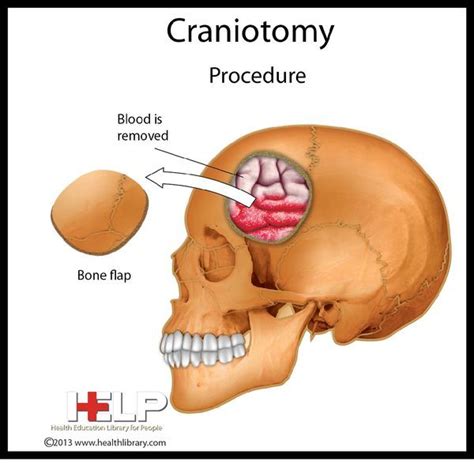 Craniotomy | nursing | Pinterest