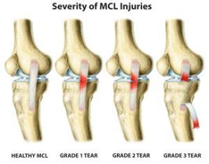 Common Questions About MCL Knee Sprains | Beacon Orthopaedics & Sports Medicine