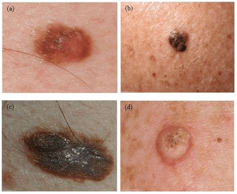 Four examples of skin lesions: (a) dysplastic nevus, (b) seborrheic ...