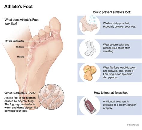 Athlete’s foot (Tinea Pedis) - Mount Lawley Physiotherapy