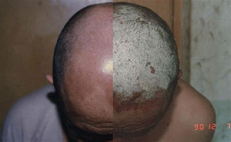 Gallery For > Plaque Psoriasis Scalp Treatment