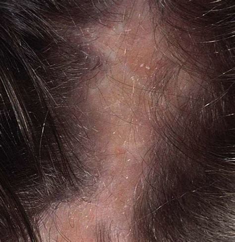 How To Treat Hair Fungal Infection At Home at Juan Acker blog