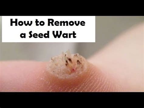 How to Remove a Seed Wart - Treatment for Seed Warts - Alayziah Wart ...