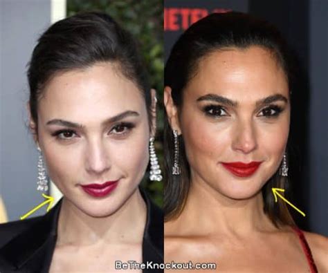 Gal Gadot Plastic Surgery Comparison Photos