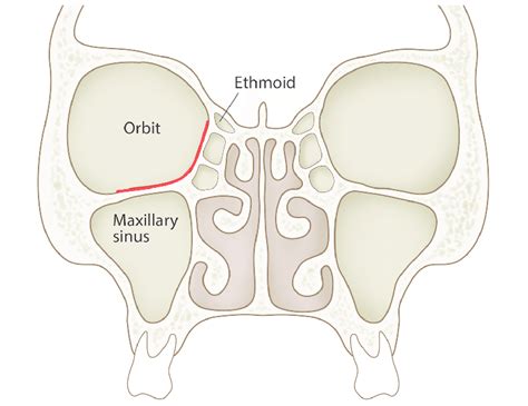 Orbital Floor Fracture Symptoms – Two Birds Home