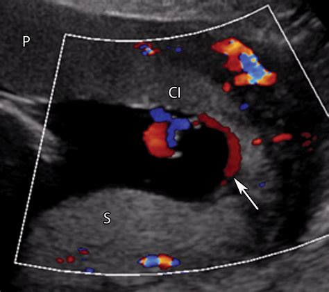 Succenturiate Lobe Placenta Ultrasound